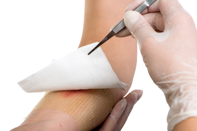 Nurse dressing a burn